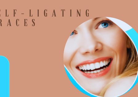 misaligned teeth
