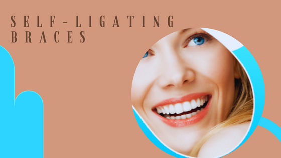 misaligned teeth