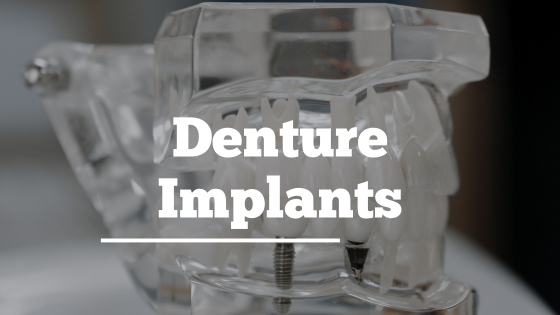 Denture Implants